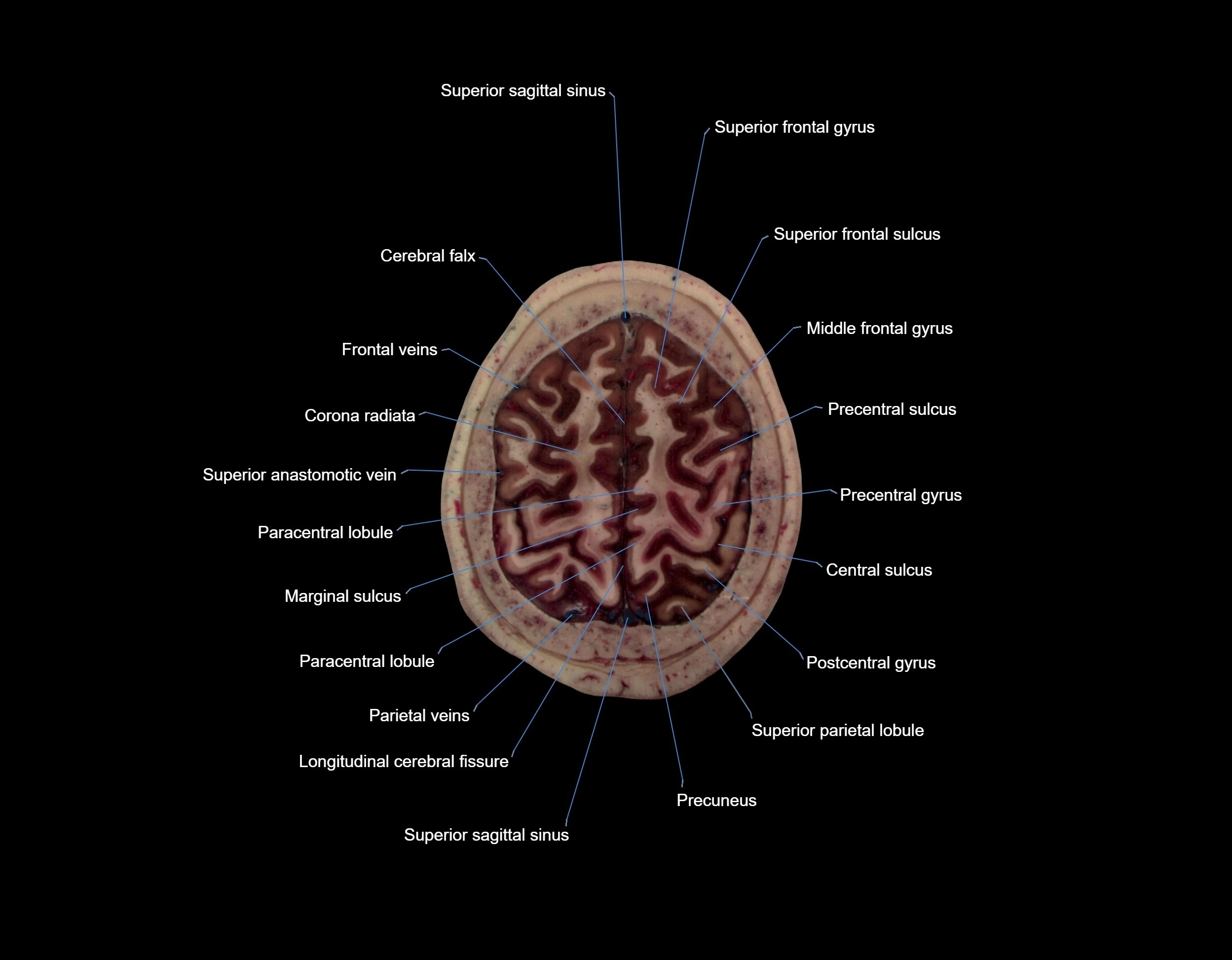 MRI Brain axial cross sectional radiology anatomy 3T image  -img-000066.webp